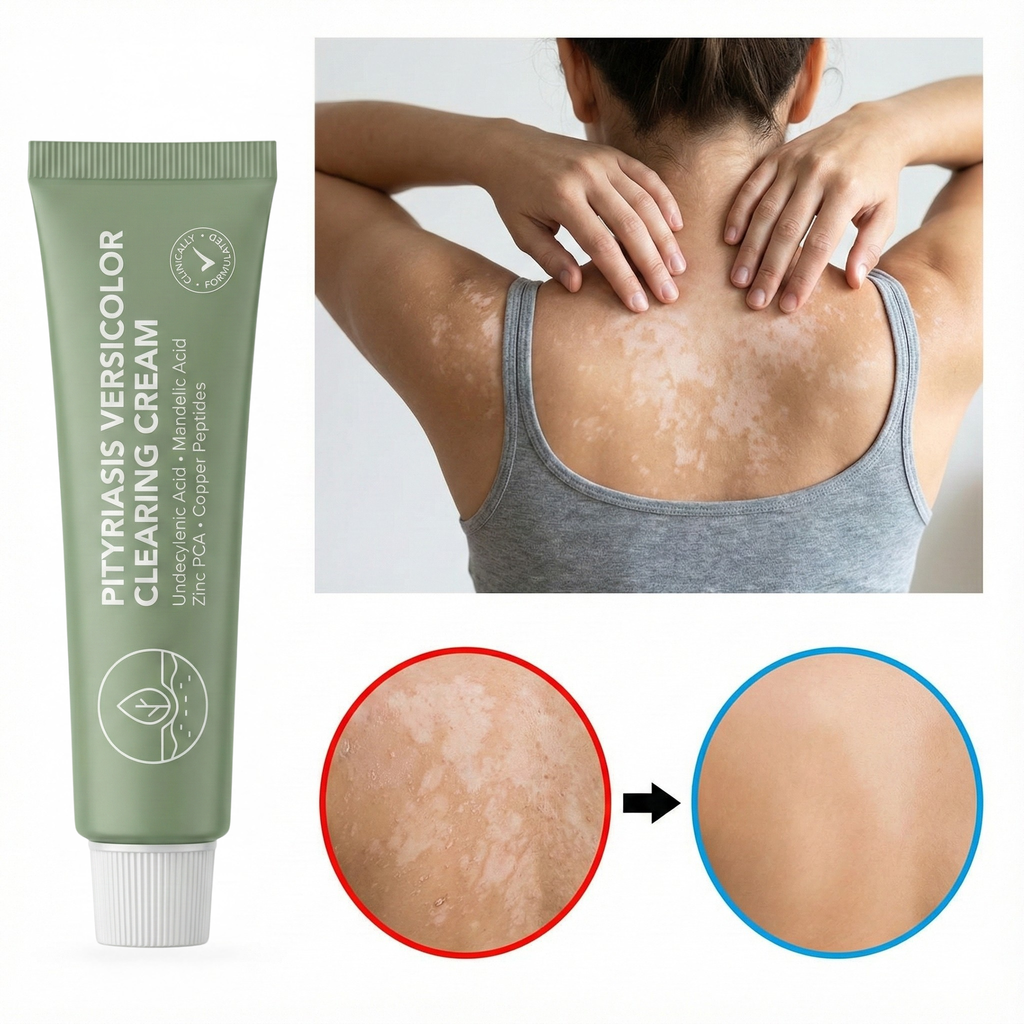 Pityriasis Versicolor Clearing Cream