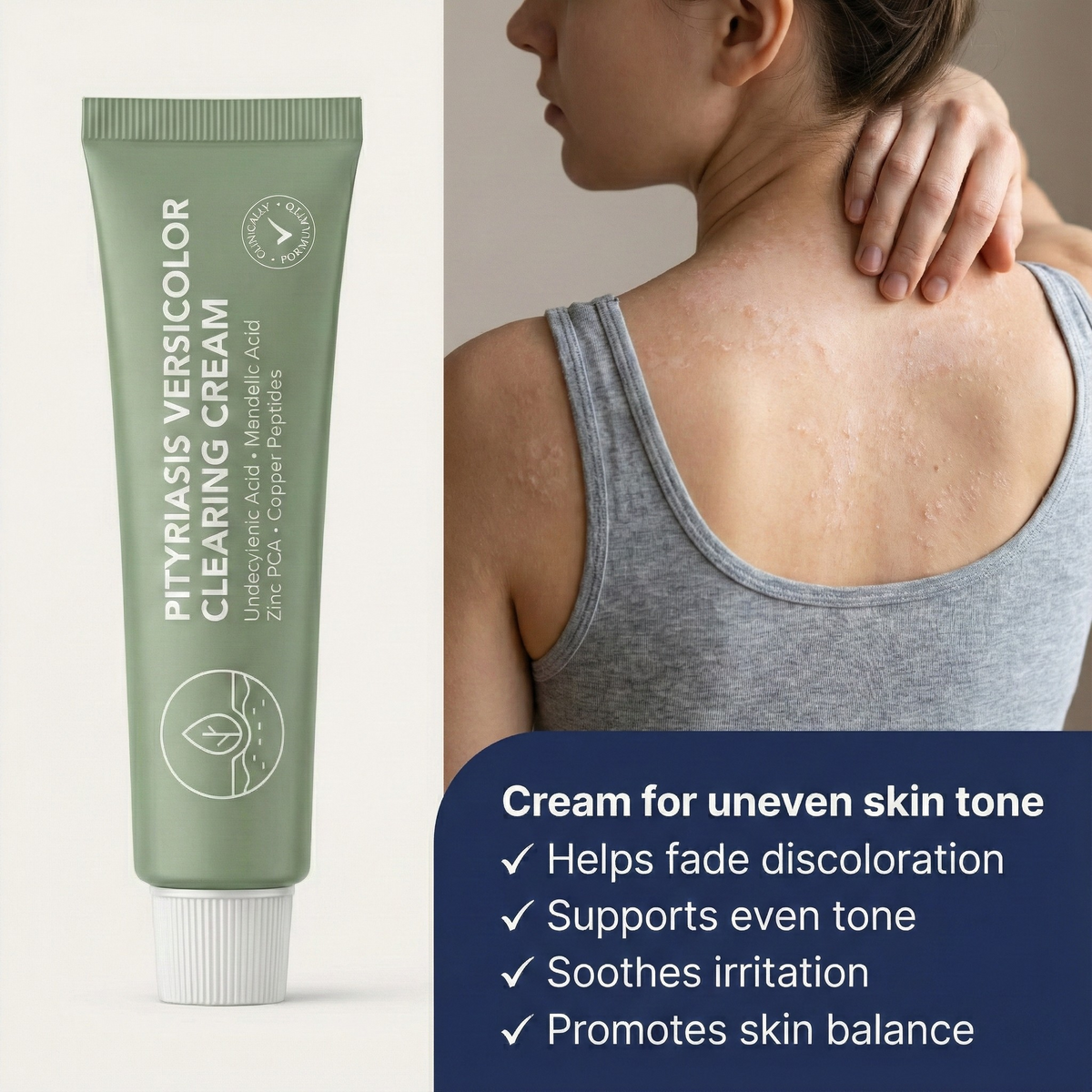 Pityriasis Versicolor Clearing Cream